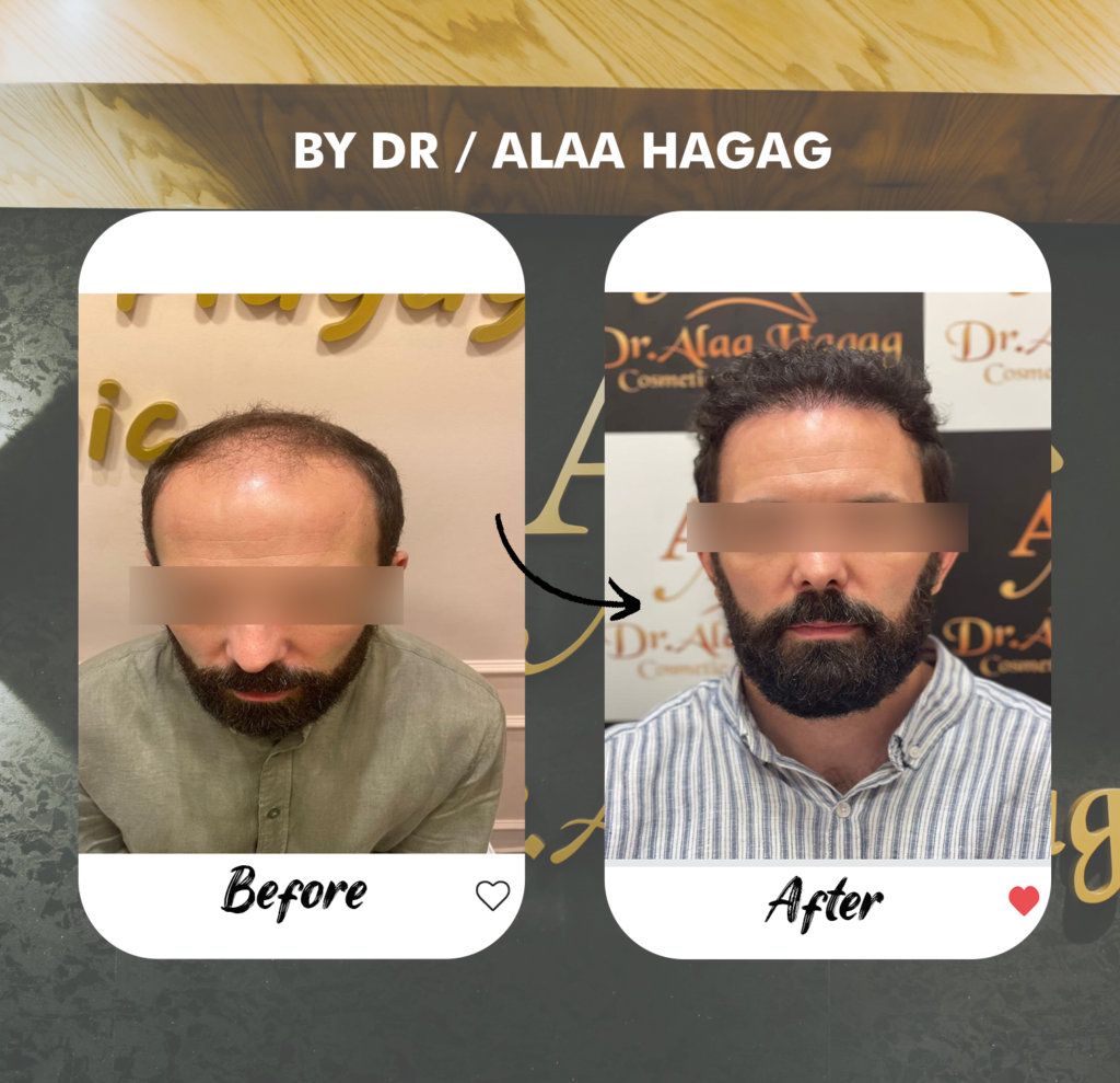 علاج فراغات الشعر بالاكسوزوم